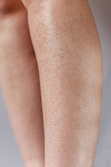 Close-up of female legs showing red rash, irritation and partial hair regrowth after epilation. Visible skin inflammation and discomfort.