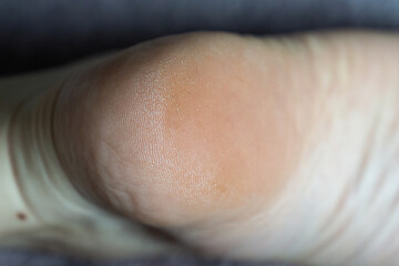 rough neglected heel of a foot, foot sole