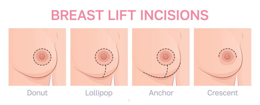 Vector illustration showing breast lift surgery techniques. Different types of incisions