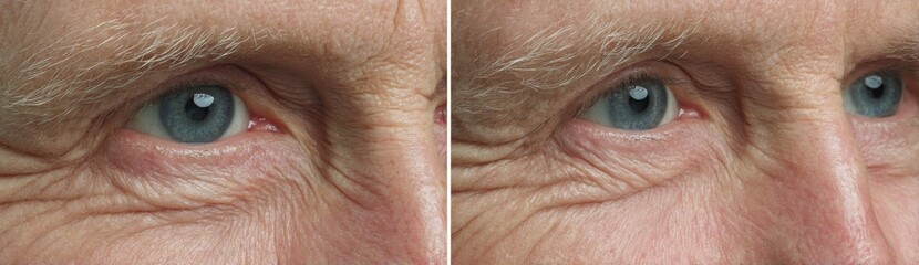Fototapeta premium Method for smoothing out eye wrinkles, including crow's feet, with a before and after comparison