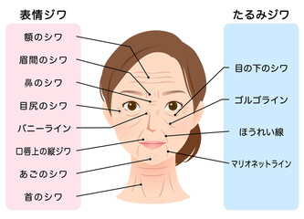 シワの種類　女性の顔　美容
