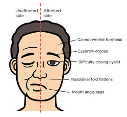 Fototapeta premium 顔面神経麻痺の症状があり目を閉じる男性の顔、正常側と麻痺側の対比