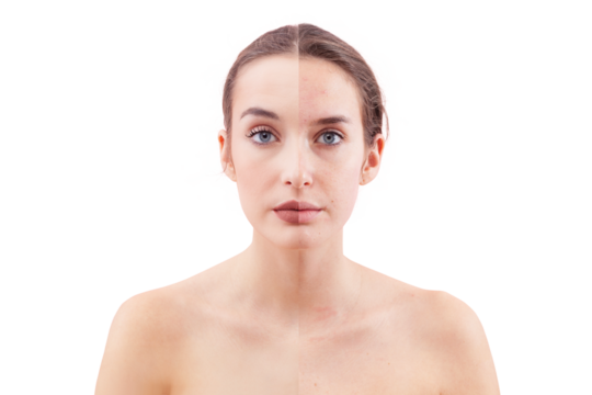 Portrait of a young woman showing a before and after face comparison of skin with and without makeup. Half and half face, left side is smooth, right side is with blemishes. Isolated background