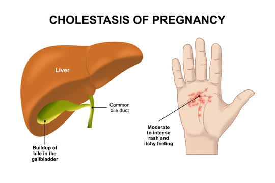 Cholestasis Of Pregnancy Illustration Liver diseases