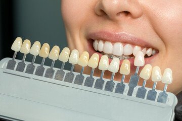 Tooth color matching with shade guide