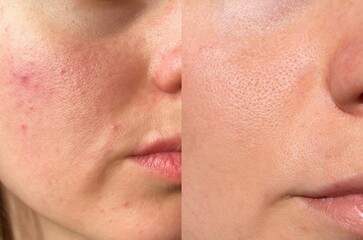 Close-up comparison of female cheek skin before and after acne treatment. Visible pore refinement,...