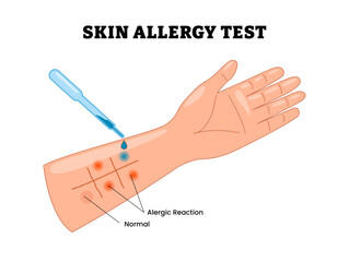 Skin allergy test with hand and arm, educational medical poster design healthcare scheme, labeled allergic reaction, diagnostic care.