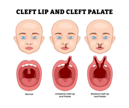 Different types of cleft lip and cleft palate with kids, educational medical poster design healthcare scheme, labeled Bilateral, Unilateral and normal, birth defect newborn, opening or gap lip.