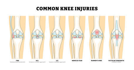 Different types of common knee injury types, educational medical poster design healthcare scheme, labeled ACL, Anterior, Cruciate, Ligament, Knee, Injury, ITBS, Iliotibial, Band, Syndrome, LCL.