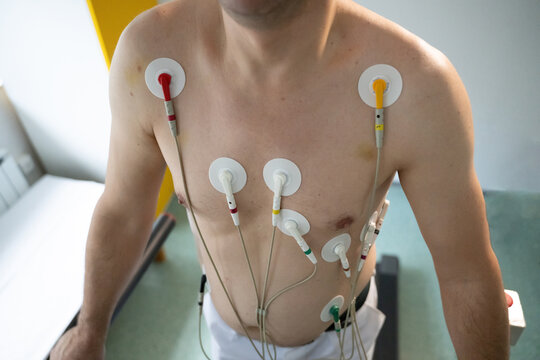A middle-aged man is undergoing a medical stress test on a treadmill, connected to ECG electrodes for heart monitoring in a clinical environment