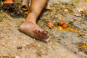 Focus is soft and blurry.The toe of the injured man, with a traumatic tear and bleeding, prevented the victim from standing up because of a foot injury and was waiting for emergency medical help.
