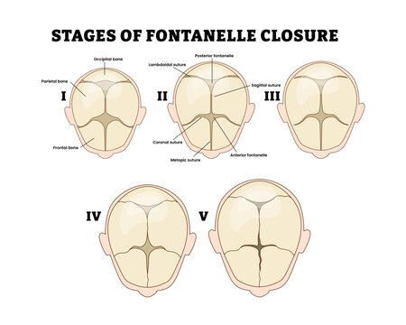 Stages of fontanelle closure stages development process, educational medical poster design healthcare scheme, labeled soft spots baby head with top view.