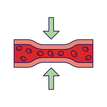 vasoconstriction