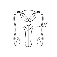 Vasectomy illustratrion