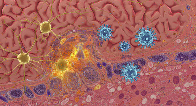 HSV-1 Infection Causing Encephalitis in Brain Tissue, Neuroviral Pathology