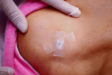 Procedure for applying anesthesia to moles and warts
