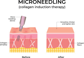 Microneedling Collagen Induction Therapy Diagram Design Vector Illustration