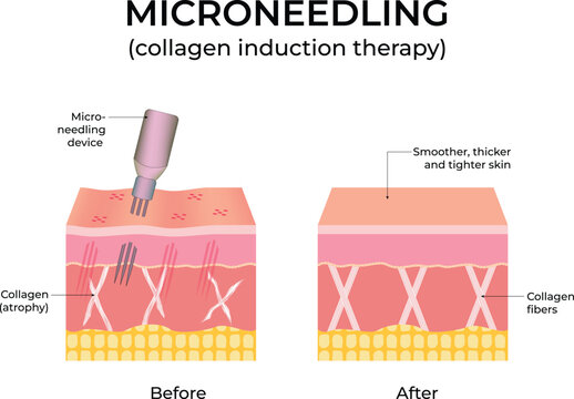 Microneedling Collagen Induction Therapy Diagram Design Vector Illustration