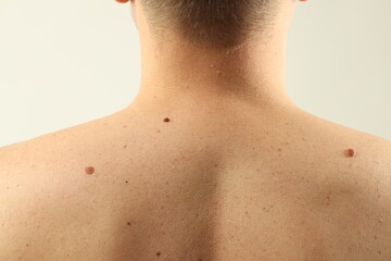 Naklejka premium Man with moles on his skin against light background, closeup