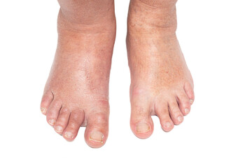 Swollen legs caused by a broken toe. Unrecognizable man with swollen feet, tired and painful legs. Tired and painful legs.