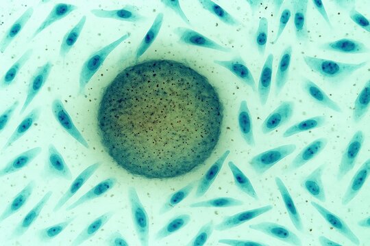 Human prostate cancer cells PC-3 under microscope