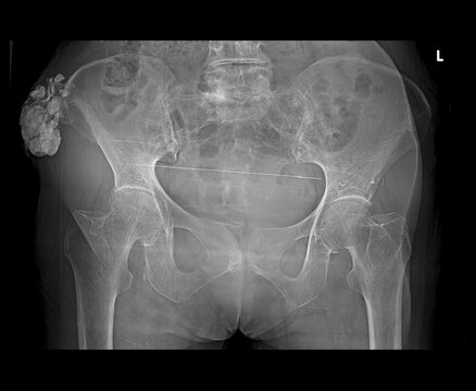 amorphous and chunky calcifications, suggesting a teratoma, liposarcoma, or possibly a calcified lymph node conglomerate.
