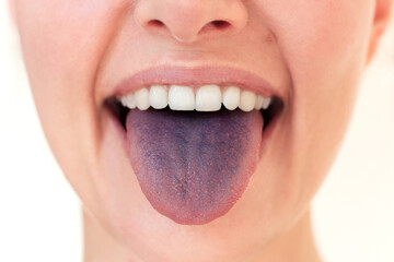 A young woman showing a stained blue tongue after eating blueberries