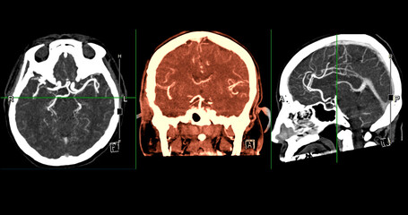 CTA Brain Vascular Imaging , highlights a detailed 3D CTA scan of the brain&rsquo;s vascular network, showing clear visualization of arteries and blood flow for diagnostic purposes.