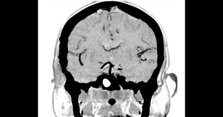 Obraz premium CTA Brain Vascular Imaging , highlights a detailed 3D CTA scan of the brain’s vascular network, showing clear visualization of arteries and blood flow for diagnostic purposes.