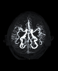 CTA Brain Vascular Imaging , highlights a detailed 3D CTA scan of the brain’s vascular network, showing clear visualization of arteries and blood flow for diagnostic purposes.