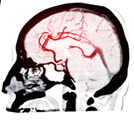 CTA Brain Vascular Imaging , highlights a detailed 3D CTA scan of the brain’s vascular network, showing clear visualization of arteries and blood flow for diagnostic purposes.
