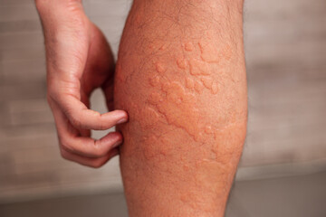 Male leg skin allergic reaction to fever.  Urticaria vasculitis disease causes itchy wheals. Angioedema . Infection rash