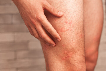 Male leg skin allergic reaction to fever.  Urticaria vasculitis disease causes itchy wheals. Angioedema . Insect bite rash