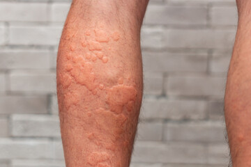 Male leg skin allergic reaction to fever.  Urticaria vasculitis disease causes itchy wheals. Angioedema . Insect bite rash