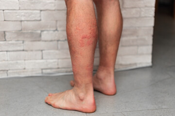 Male leg skin allergic reaction to fever.  Urticaria vasculitis disease causes itchy wheals. Angioedema . Insect bite rash
