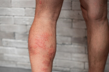 Male leg skin allergic reaction to fever.  Urticaria vasculitis disease causes itchy wheals....