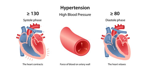 Hypertension. Medical illustration of high blood pressure. Phases of systole and diastole of heart. Drawing of an artery in section. Vector illustration in flat style isolated over white background
