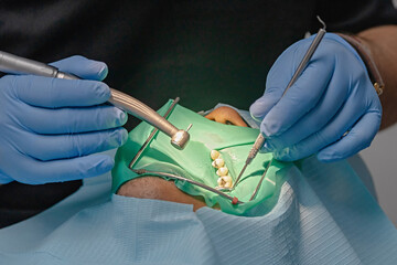 Close-up view of a dental treatment with a rubber dam in place. Multiple tools and gloved hands during tooth procedure. Concept of endodontics, surgery, or dental restoration.