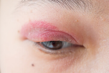 Close up of swelling and red eyelid allergic reaction