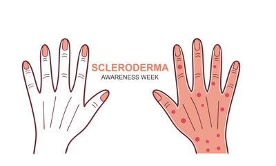 Scleroderma Awareness Week. Scleroderma concept illustration.