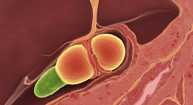 Echinococcus granulosus hydatid cyst in liver