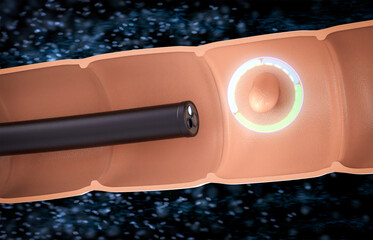 Endoscope with colonic polyp in intestine