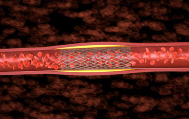 Balloon angioplasty procedure with stent in vein