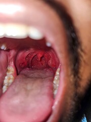 Close-up photograph depicting acute pharyngitis and tonsillitis, common medical conditions affecting the throat.