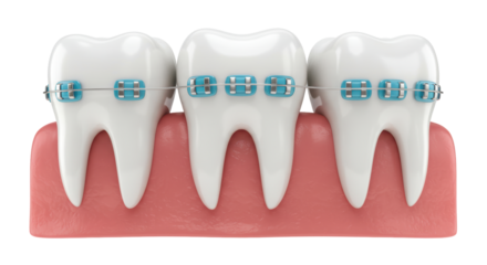 Isolated Teeth with Braces
