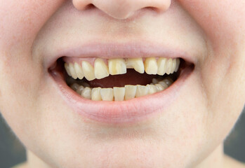 Close up view of adult woman mouth with broken front tooth. A broken front tooth needs to be...