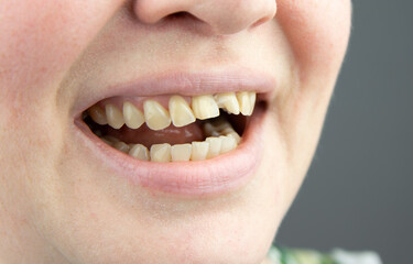 Close up view of adult woman mouth with broken front tooth. A broken front tooth needs to be repaired. Teeth dental care concept.