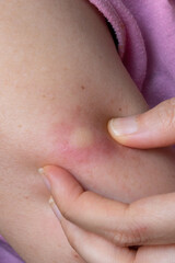 Fototapeta premium Woman examining inflamed pustule on arm: skin infection close-up