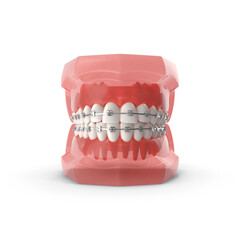 Transparent Dental Jaw Model with Orthodontic Braces Isolated on Transparent Background