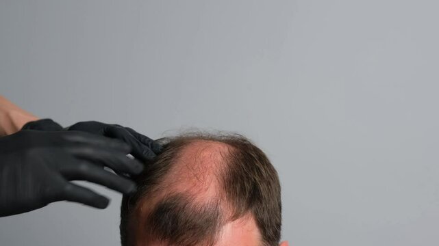 A close-up of a man's head with visible hair loss and thinning on the crown, as a person wearing black gloves examines the scalp. Concept of baldness treatment or hair restoration.